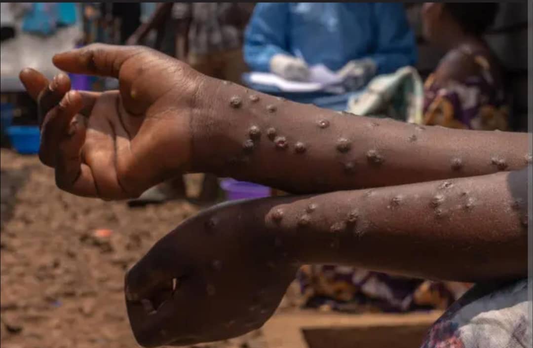 WHO Donates Mpox Vaccines to Zambia