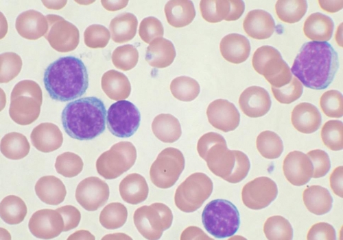 BLOOD TEST COULD SPOT LEUKEMIA 